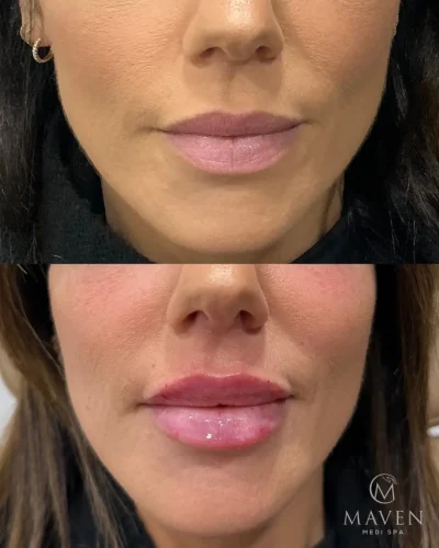 Lip Filler Before And After Comparison Showing Fuller Lips in Beverly Hills, CA | Maven Medi Spa
