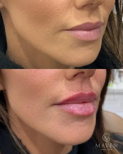 Lip Filler Before And After Results Showing Enhanced Lip Volume in Beverly Hills, CA | Maven Medi Spa