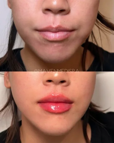 Before & After Lip Technique